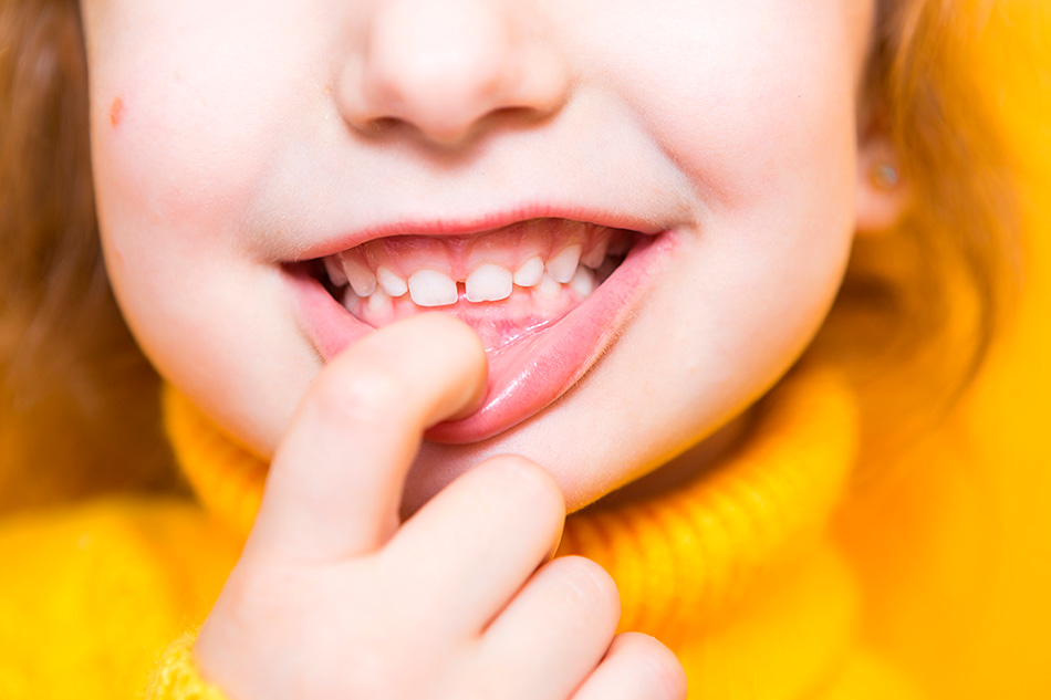 Caries en niños